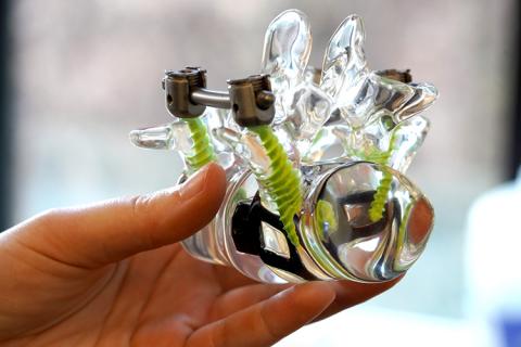 A member of team Frequent Fusion holds a model showing a segment of the spinal column after spinal fusion surgery, which is commonly used to fuse bones in the spinal cord to reduce chronic neck pain. For their prototype, the team designed an implantable rod connected to an electrical stimulator. The device encourages bone growth in the spinal column after surgery. A member of team Frequent Fusion holds a model showing a segment of the spinal column after spinal fusion surgery, which is commonly used to fuse bones in the spinal cord to reduce chronic neck pain. For their prototype, the team designed an implantable rod connected to an electrical stimulator. The device encourages bone growth in the spinal column after surgery.